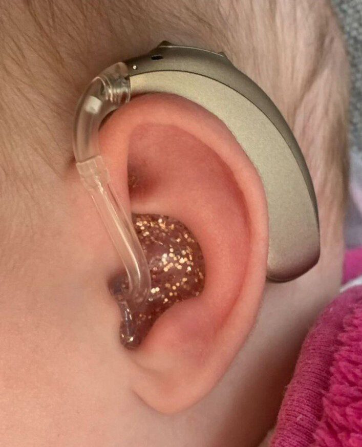 Nahaufnahme eines Kinderhörgeräts mit glitzernder Otoplastik.