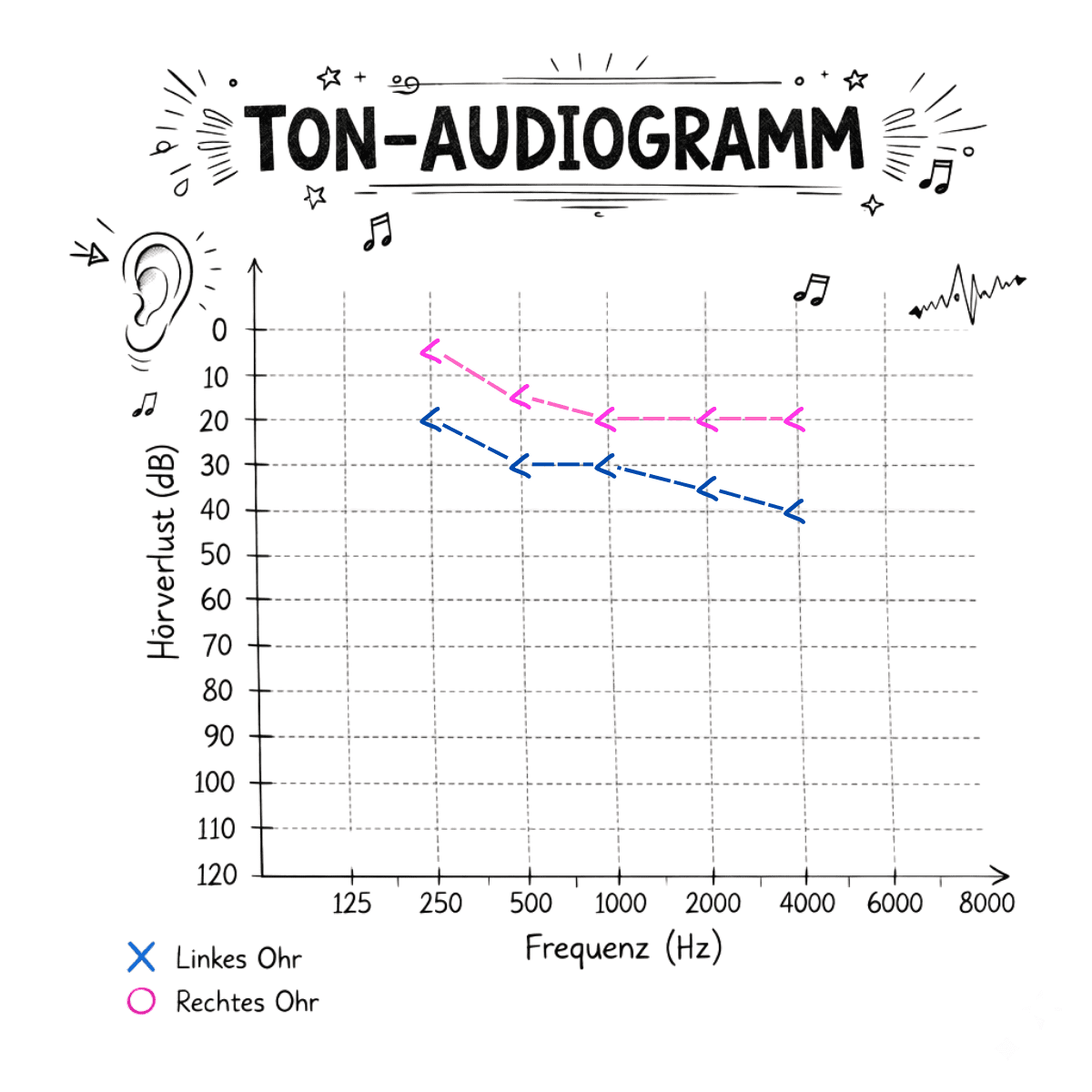 Tonaudiogramm mit markierten Knochenleitungswerten.